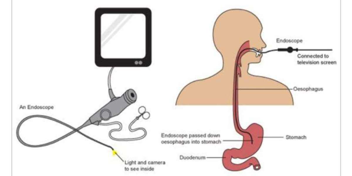 Instruments Used to Perform a Gastroscopy: A Comprehensive Guide