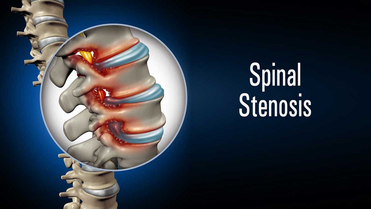 Optimize Spinal Stenosis Surgery Recovery: Nutrition Guide | Medium
