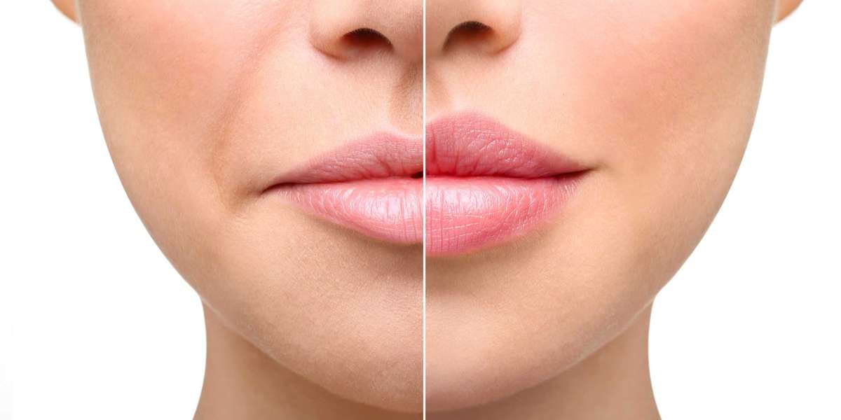 The Ultimate Guide to Lip Injections: What You Need to Know