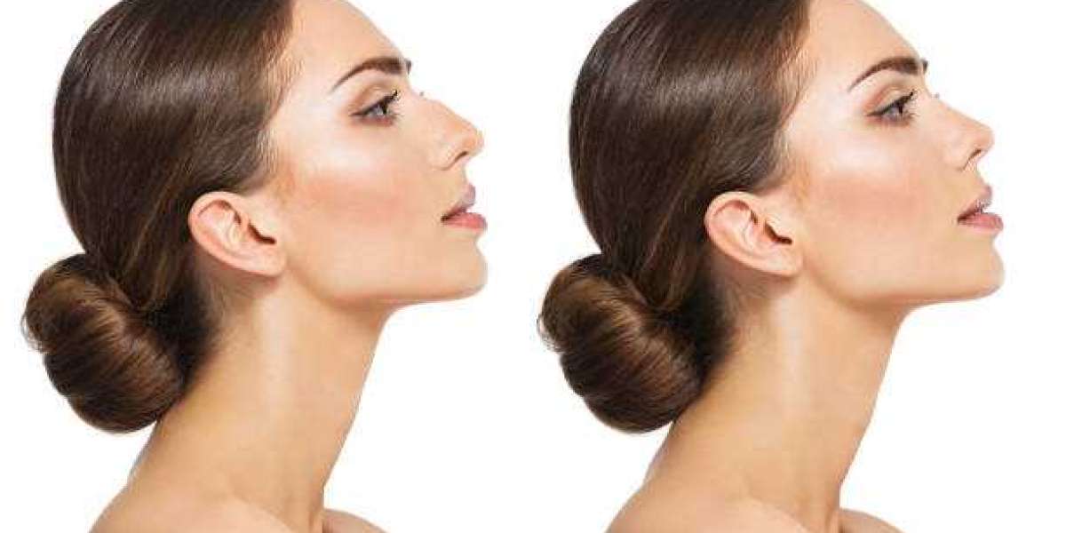 Radiate Confidence with Your New Nose: Rhinoplasty in Riyadh