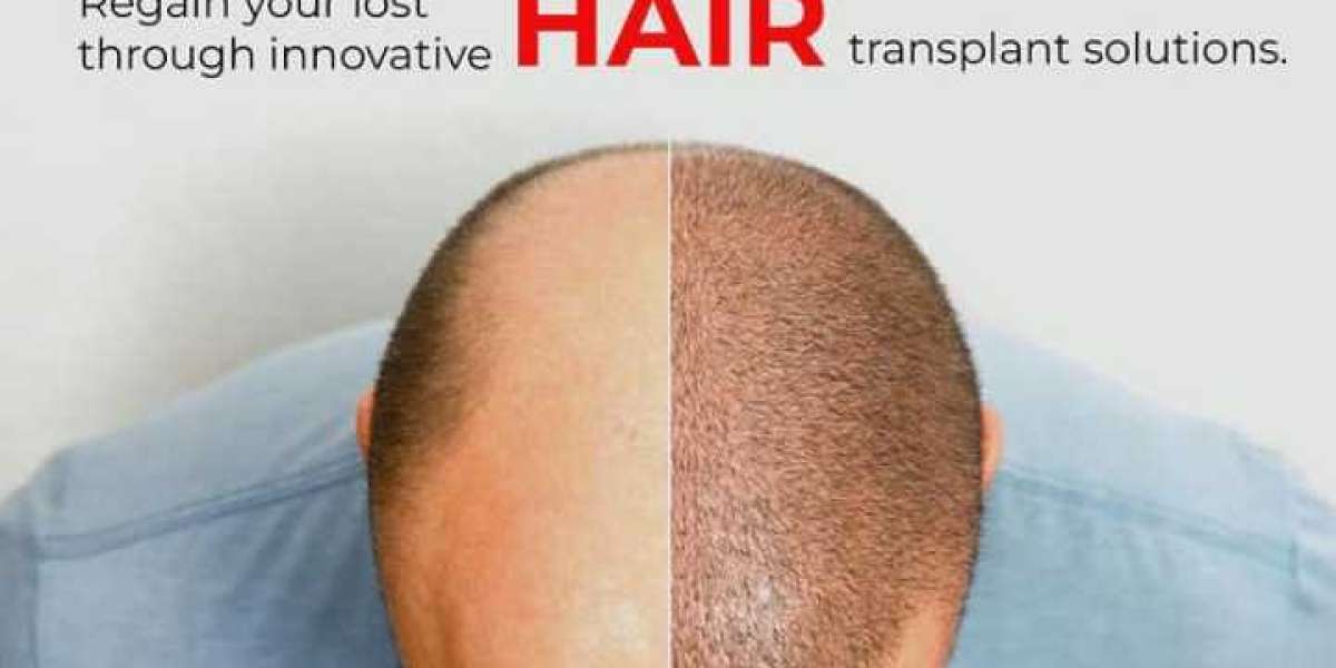 Best Hair Transplantation Treatment In Hyderabad - Ameyaa Hair Transplant centre