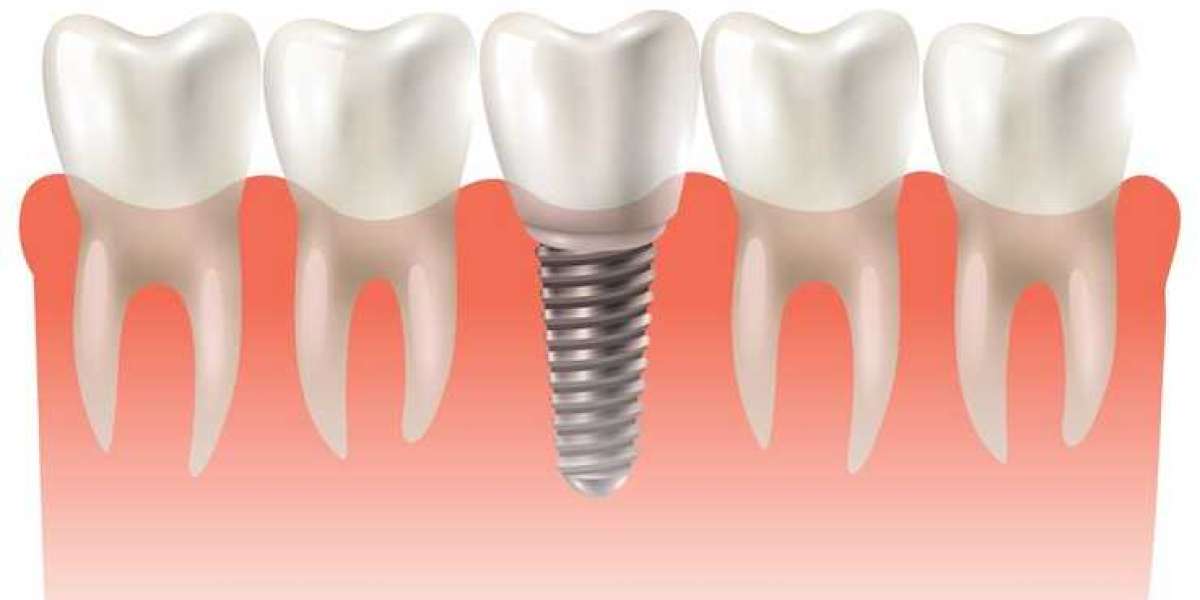 Transform Your Smile with Dental Implants in Crestview, FL