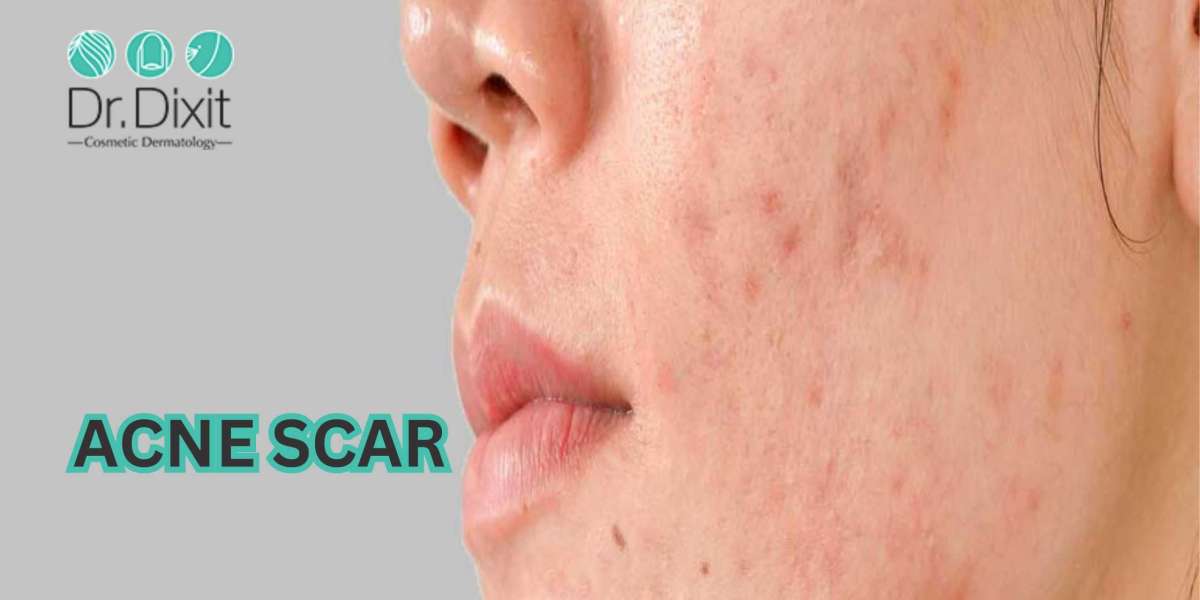 Reduce Your Acne Scars & Get a Crystal Clear Skin