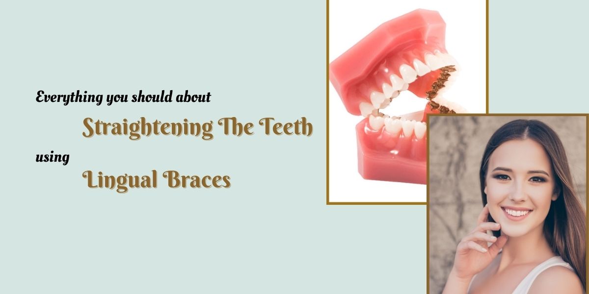 About straightening the teeth using lingual braces