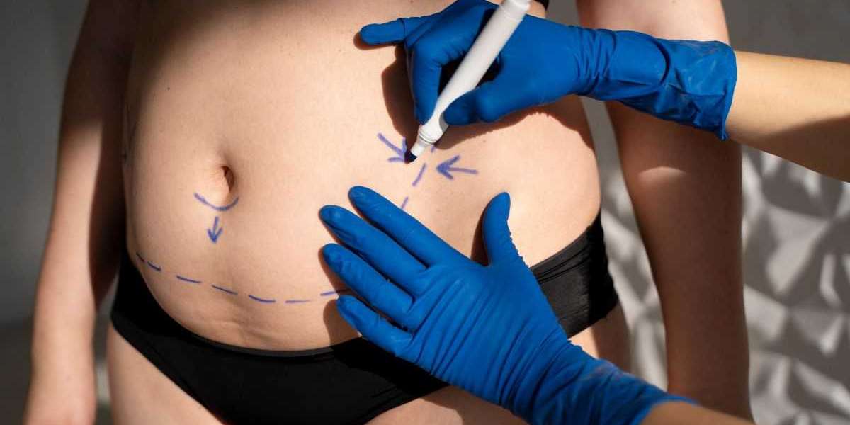 Belly Beautiful: Unlocking Abdominal Liposuction in Riyadh