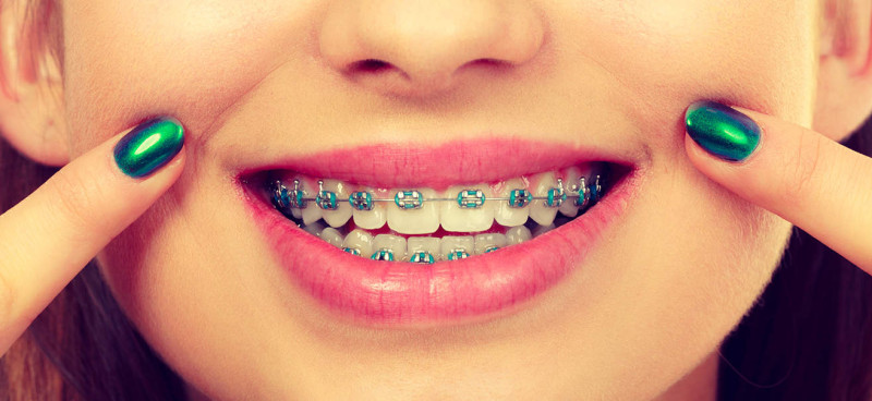 Your FAQs on Braces Treatment Answered! : laderaorthoca — LiveJournal