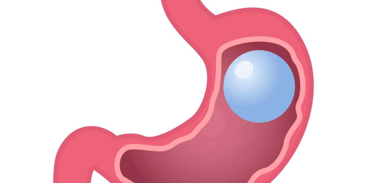 How Gastric Balloons Can Jumpstart Your Weight Loss Journey