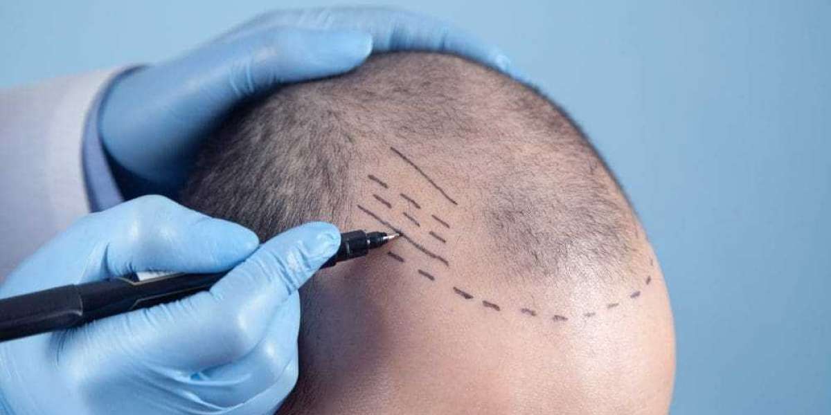 Hair Plugs Cost in Riyadh: What You Need to Know Before You Go