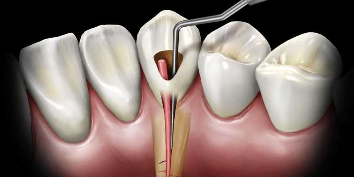 Save Your Smile: Understanding Root Canal Treatment Costs at Teeth and Smile