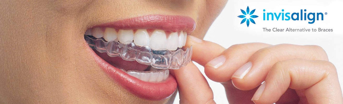5 Reasons Why Invisalign Might Be Your Perfect Smile Solution – Telegraph