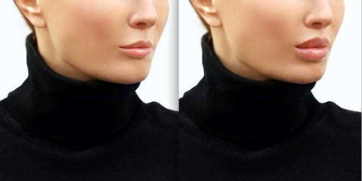 Riyadh's Lip Transformation Hub: Enhance Your Beauty
