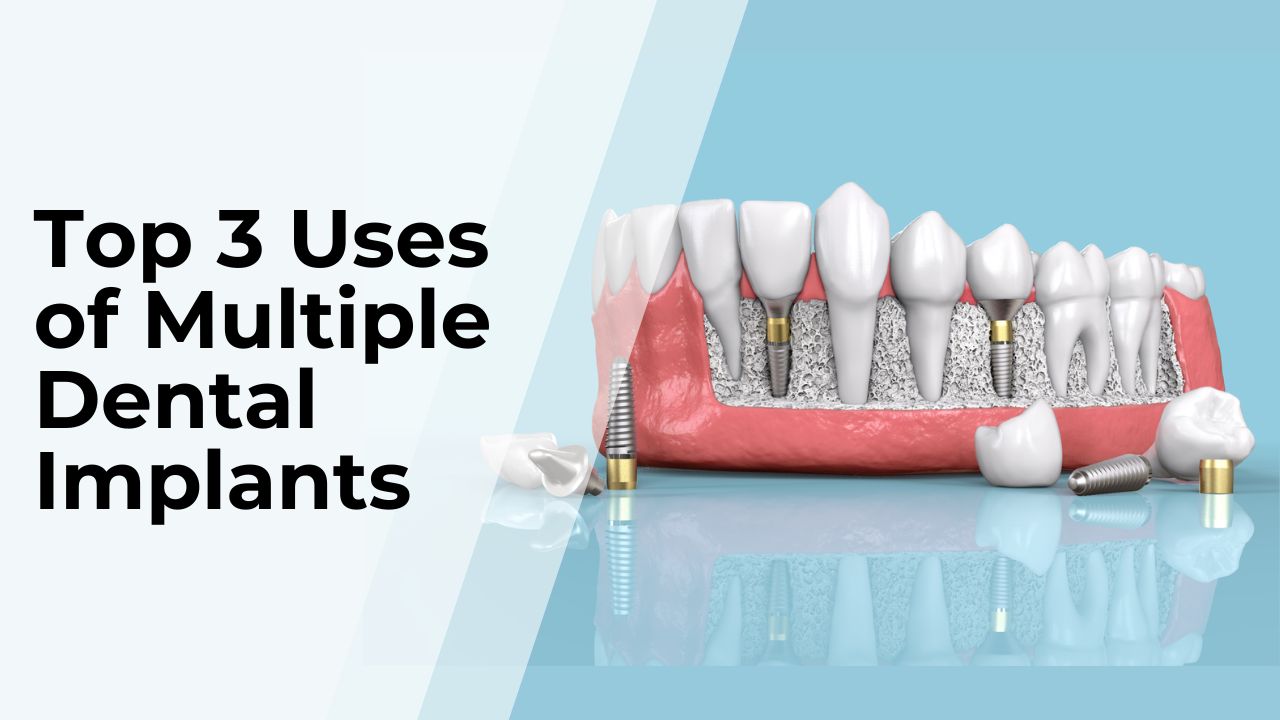 Top 3 Uses of Multiple Dental Implants in Kolkata