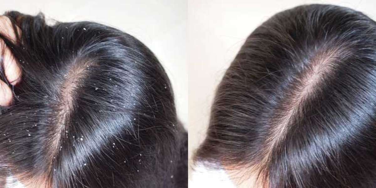 Hair Dandruff Treatment in Chennai