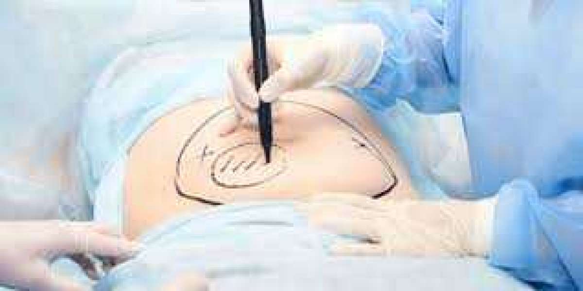 Expert Insights: What Surgeons Are Saying About GPS Laser Liposuction