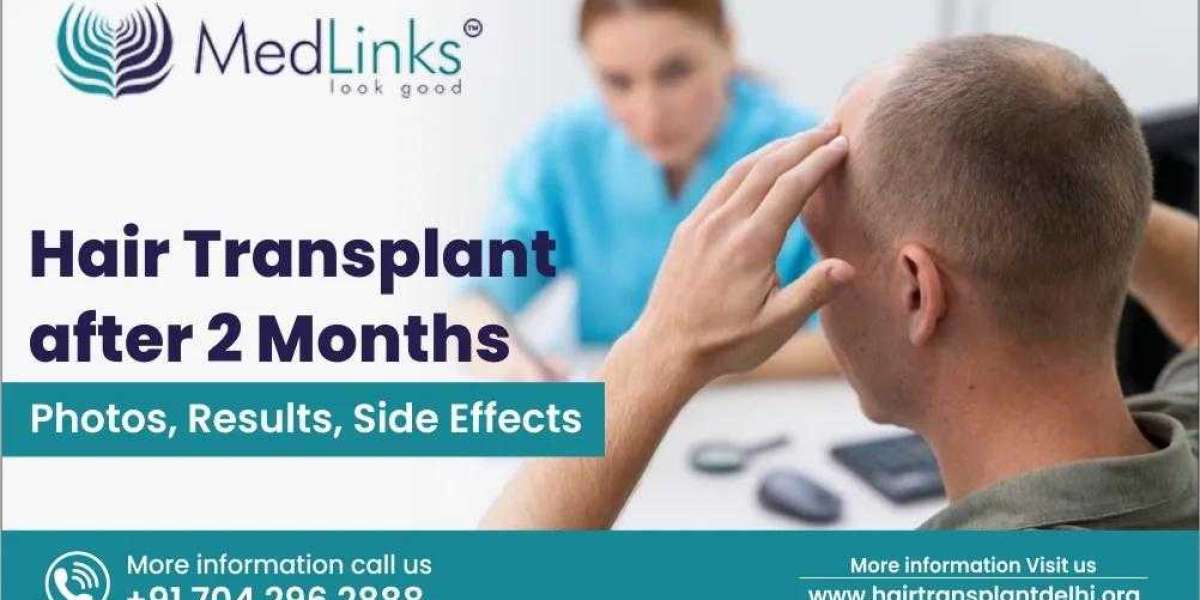 Hair Transplant After 2 Months: What to Expect in Terms of Photos, Results, and Side Effects