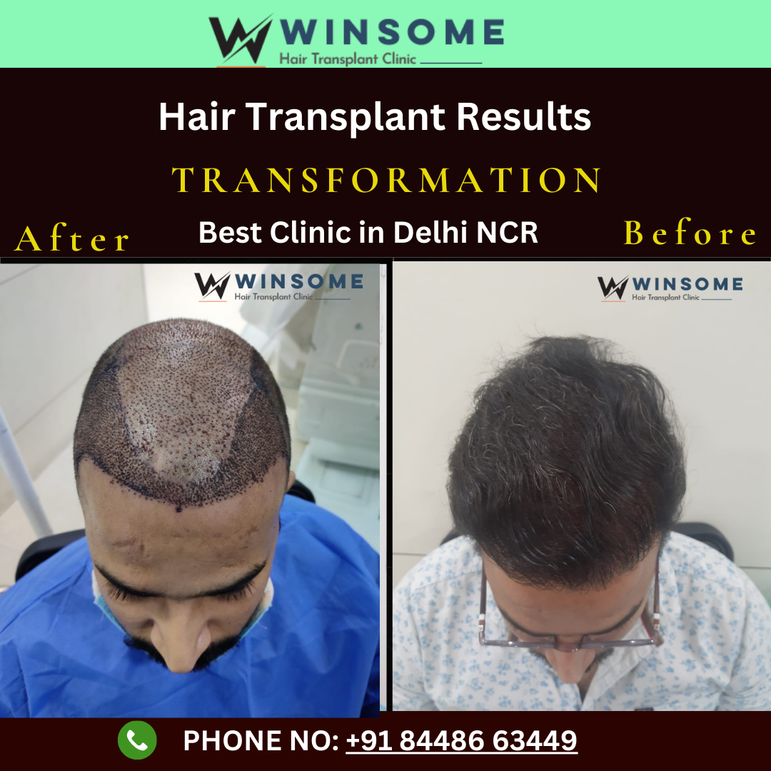 Best Hair Transplant Clinic in Noida - Call Us :- 8448663449